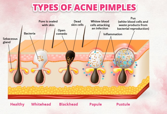 different Types of acne pimples